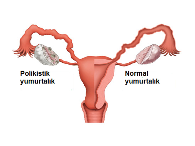 Polycystic ovary syndrome symptoms