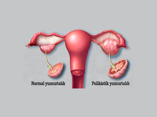 What is polycystic ovary?